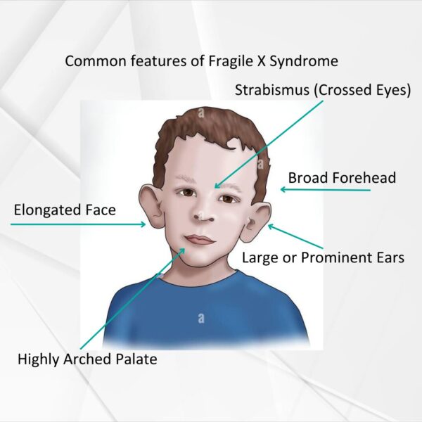 Understanding Fragile X Syndrome A Guide For Families And Loved Ones Understanding Fragile X Syndrome A Guide For Families And Loved Ones